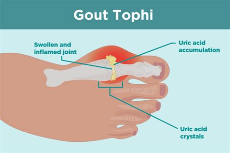 Gout .